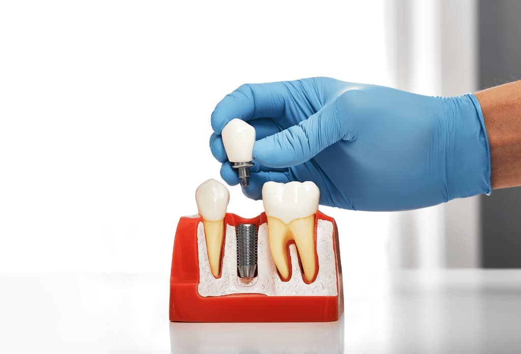 Exploring Different Types of Dental Implants