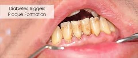 Oral health and diabetes