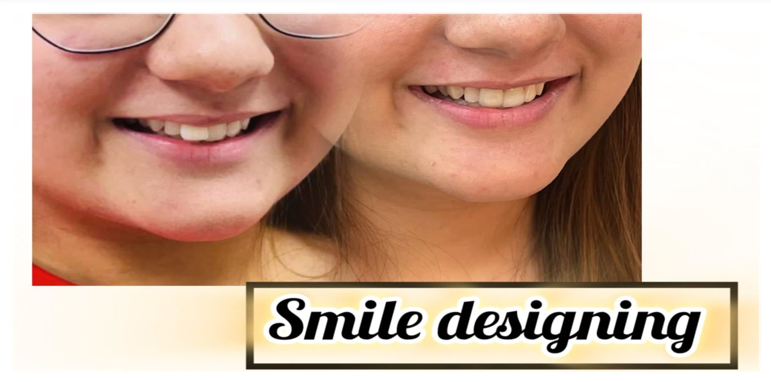 Smile Designing