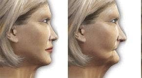 Tooth replacement options for elderly patients