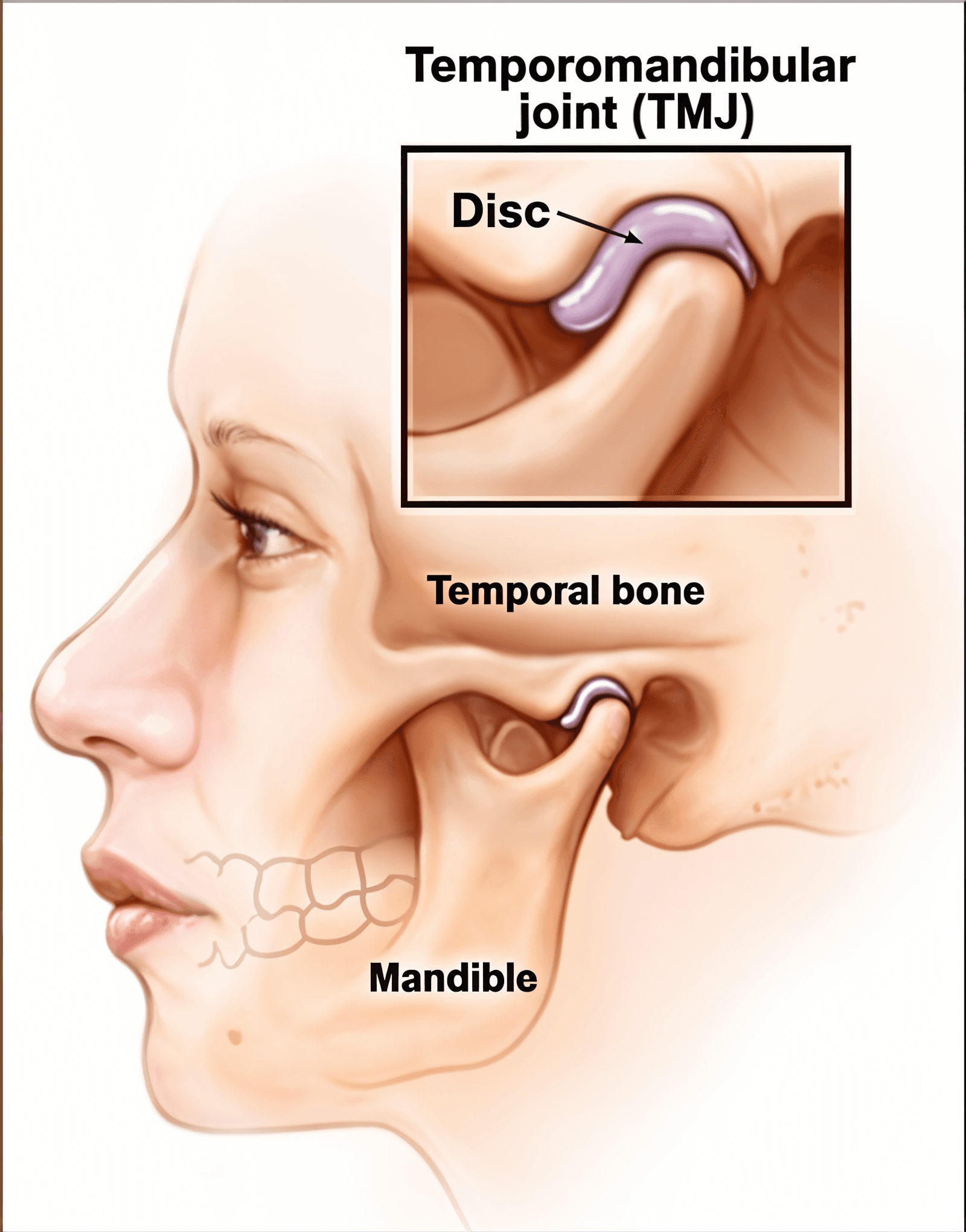 Understanding Temporomandibular Disorder (TMD)