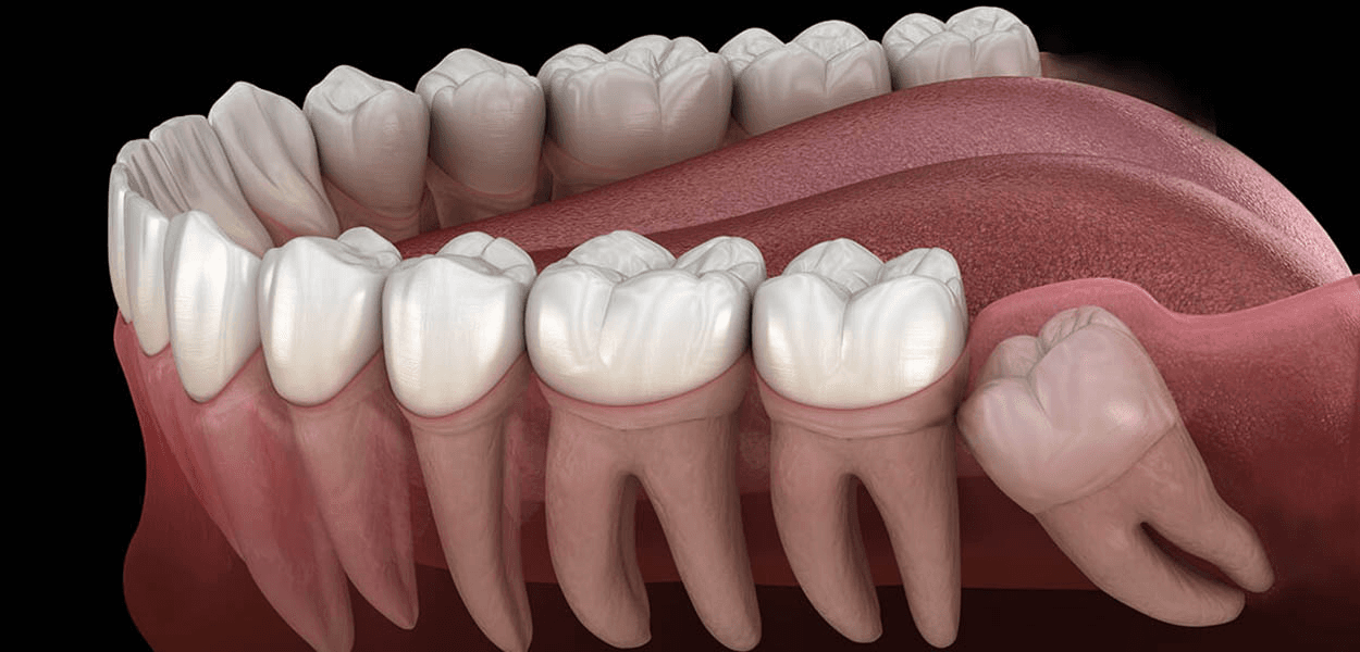Impacted Teeth Solution